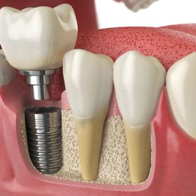 Restore Your Smile with Advanced Dental Implantsin China