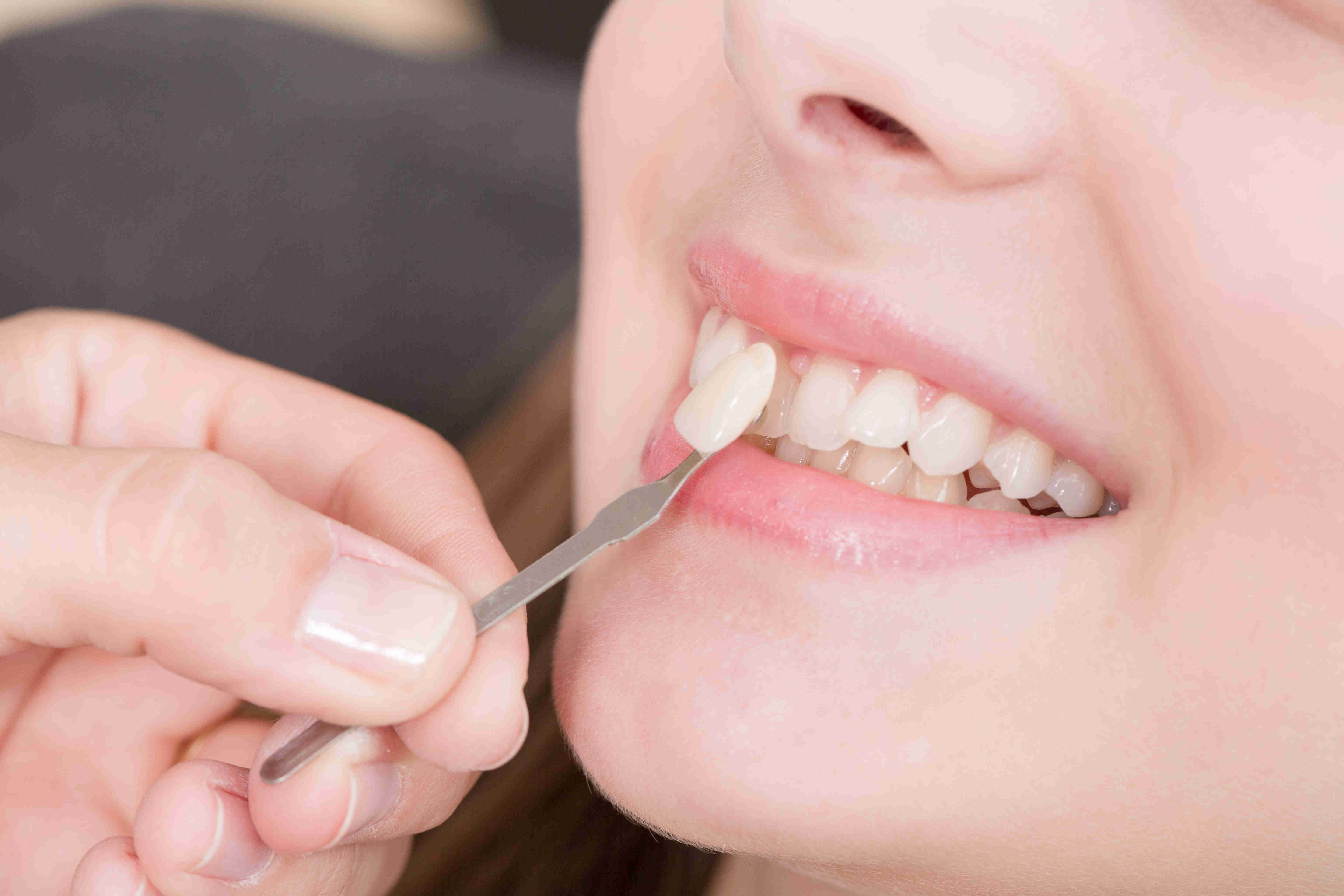 01_Veneers visual.jpg