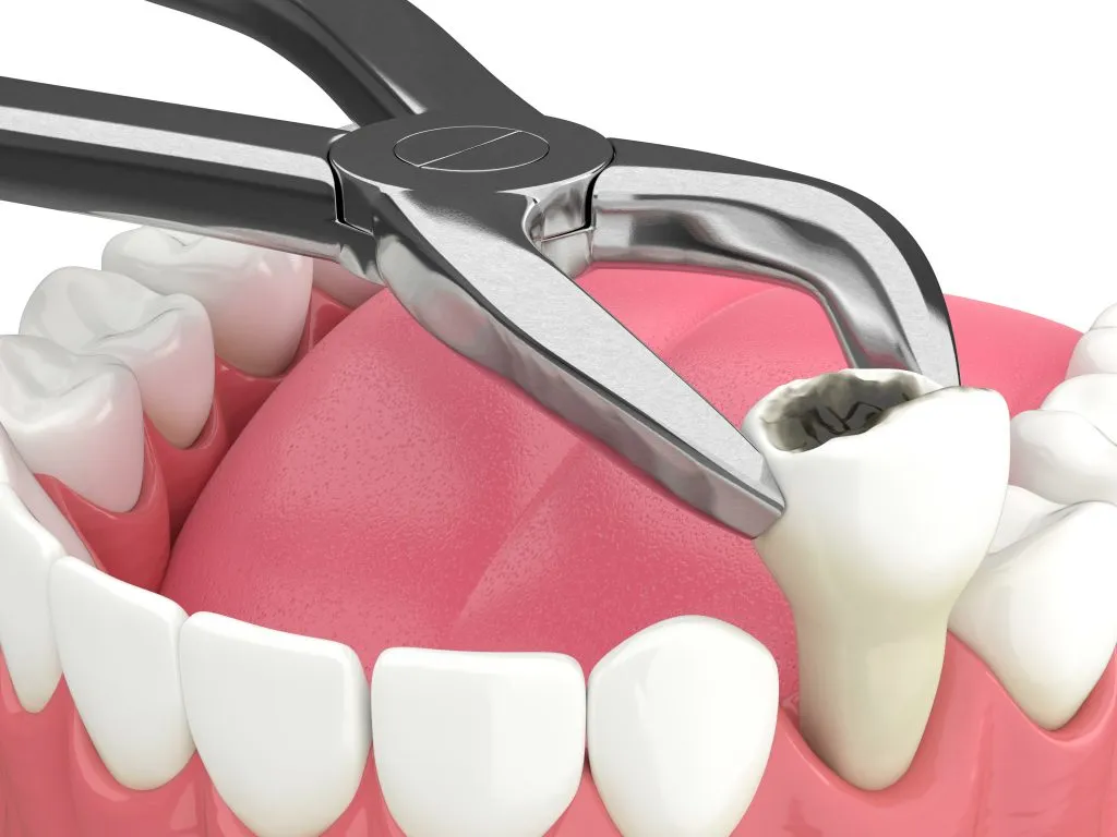Tooth-Extraction-1024x768.webp
