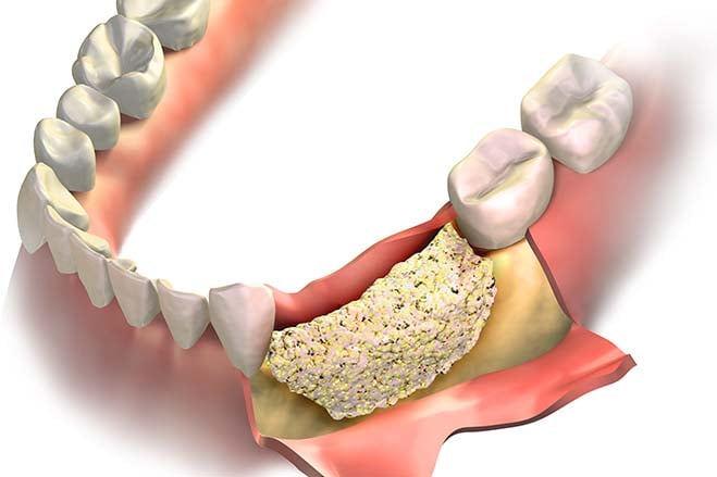 bone-grafting-dental-care-oral-health-check-up.jpg