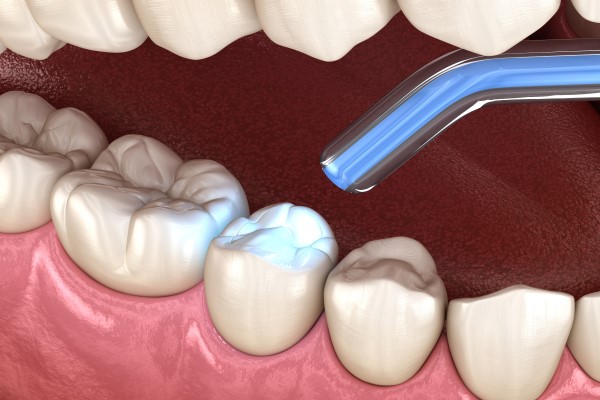 composite-fillings-2504.jpg