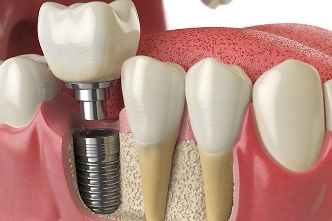 dental-implants.jpg