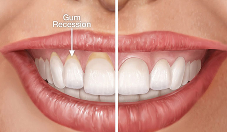 gum-recession-before-after.jpg
