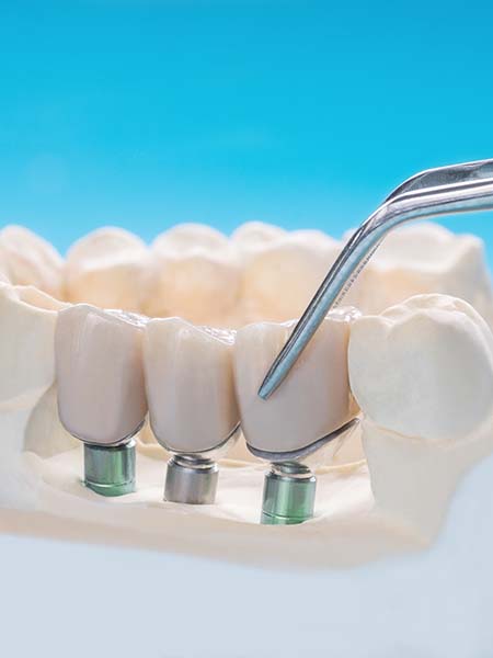 what-are-multi-teeth-dental-implants-oral-health-dental-care(1).jpg