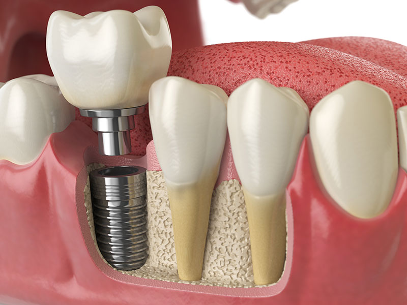 Restore Your Smile with Advanced Dental Implantsin China